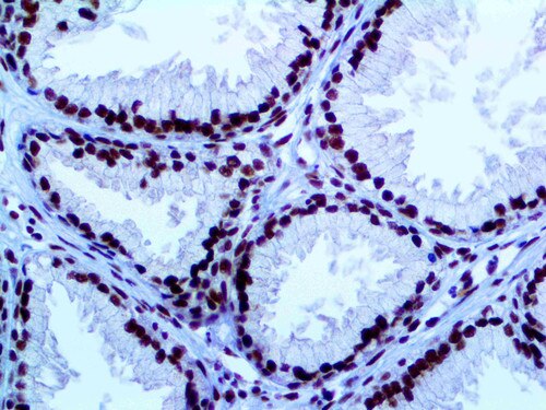 IHC of E2F4 on an FFPE Prostatic Adenocarcinoma Tissue